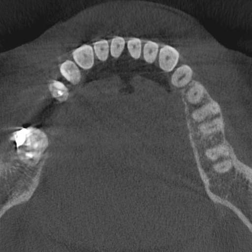 File:Cemento-osseous dysplasia (Radiopaedia 48251-53126 Axial non-contrast 51).jpg