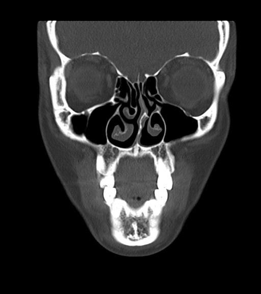 File:Cemento-ossifying fibroma (Radiopaedia 46243-50643 Coronal bone window 18).png