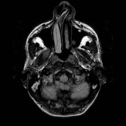File:Central-variant posterior reversible encephalopathy syndrome (PRES) (Radiopaedia 43880-47358 Axial FLAIR 1).jpg