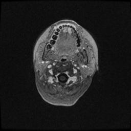 Central neurocytoma (Radiopaedia 30220-30842 Axial T1 C+ 5).jpg