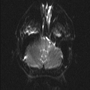 Central neurocytoma (Radiopaedia 56690-63469 Axial DWI 2).jpg