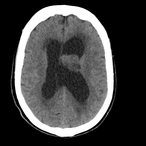 Central neurocytoma (Radiopaedia 65317-74346 Axial non-contrast 30).png