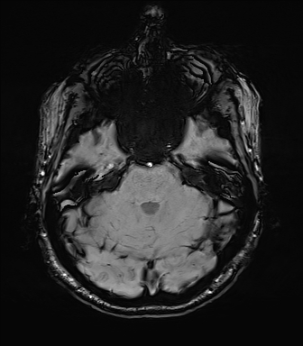 Central neurocytoma (Radiopaedia 71068-81303 Axial SWI 14).jpg