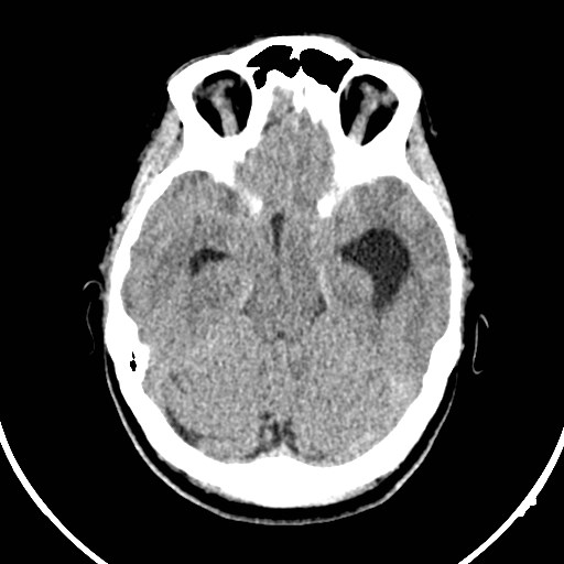 Central neurocytoma (Radiopaedia 84497-99871 Axial non-contrast 15).jpg
