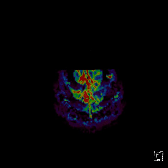 Central neurocytoma (Radiopaedia 84497-99872 Axial Perfusion 10).jpg