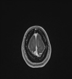 File:Central neurocytoma (Radiopaedia 84497-99872 Axial T1 C+ 141).jpg