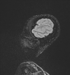 File:Central neurocytoma (Radiopaedia 84497-99872 Sagittal Flair + Gd 136).jpg