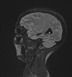 Central neurocytoma (Radiopaedia 84497-99872 Sagittal Flair + Gd 46).jpg