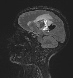 Central neurocytoma (Radiopaedia 84497-99872 Sagittal Flair + Gd 92).jpg