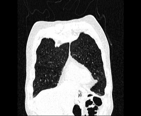 Centrilobular pulmonary emphysema (Radiopaedia 62468-70718 Coronal lung window 13).jpg