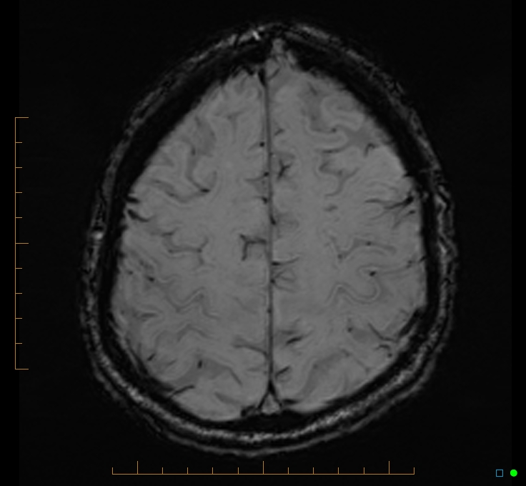 Cerebellar gangliocytoma (Radiopaedia 65377-74422 Axial SWI 47).jpg