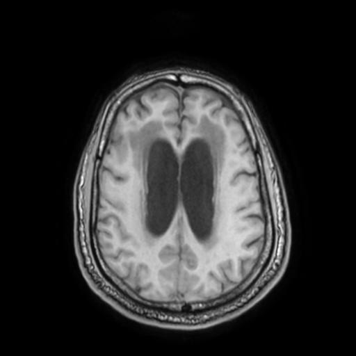 File:Cerebellar hemangioblastoma (Radiopaedia 88055-104622 Axial T1 25).jpg