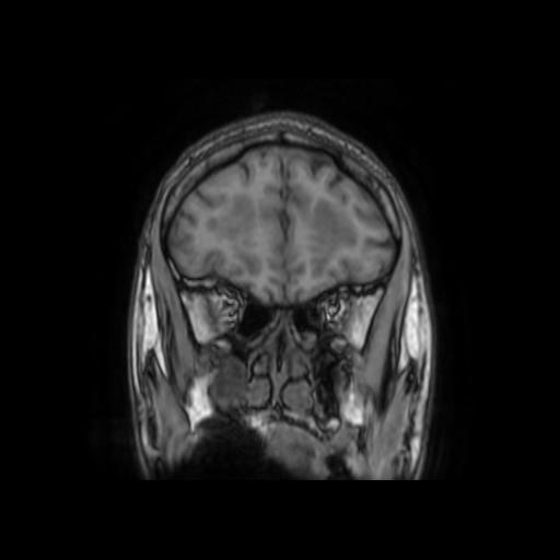 File:Cerebellar hemangioblastoma (Radiopaedia 88055-104622 Coronal T1 9).jpg