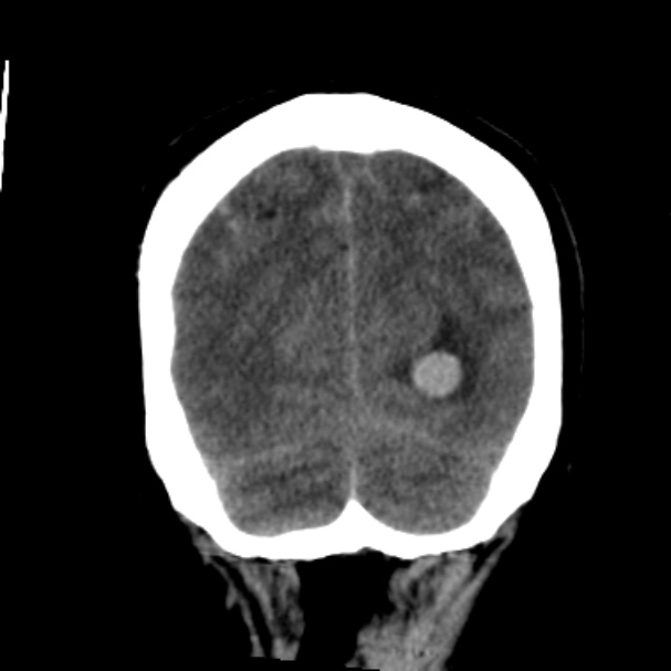 Cerebellar hemorrhage causing obstructive hydrocephalus (Radiopaedia 33989-35207 Coronal non-contrast 45).jpg