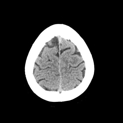 Cerebellar metastasis (Radiopaedia 54578-60812 Axial non-contrast 43).png
