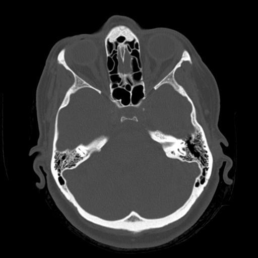 Cerebellar metastasis (cystic appearance) (Radiopaedia 41395-44258 Axial bone window 18).png