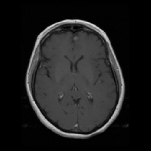 File:Cerebellar metastasis (cystic appearance) (Radiopaedia 41395-44262 Axial T1 C+ 11).png