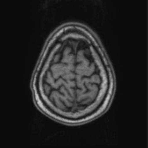 Cerebellar metastasis from lung adenocarcinoma (Radiopaedia 86690-102829 Axial T1 70).png