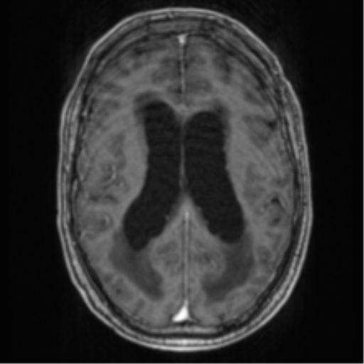 Cerebellar metastasis from lung adenocarcinoma (Radiopaedia 86690-102829 Axial T1 C+ 49).png