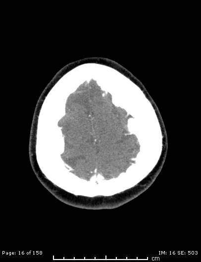 Cerebellar strokes due to intracranial giant cell arteritis (Radiopaedia 68799-78510 CT angiogram 16).jpg