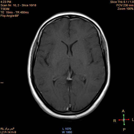File:Cerebellopontine angle meningioma (Radiopaedia 22488-22525 Axial T1 C+ 9).jpg