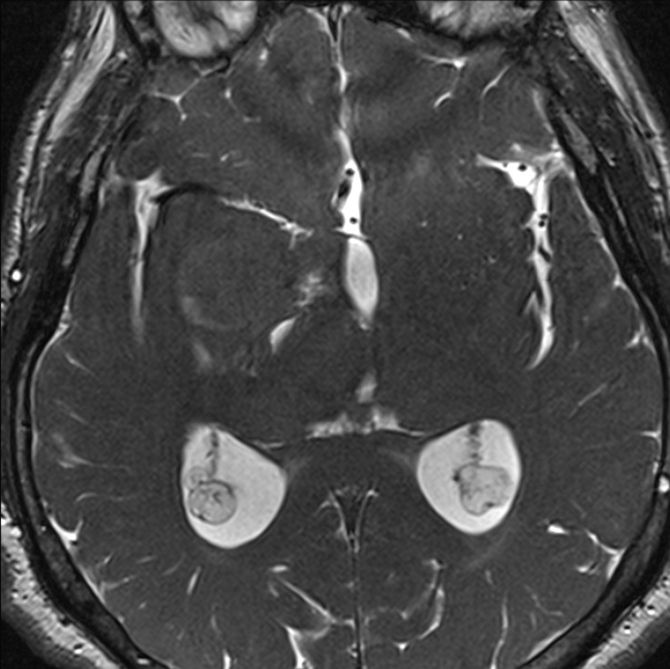 Cerebellopontine angle meningioma (Radiopaedia 24459-24764 I 51).jpg