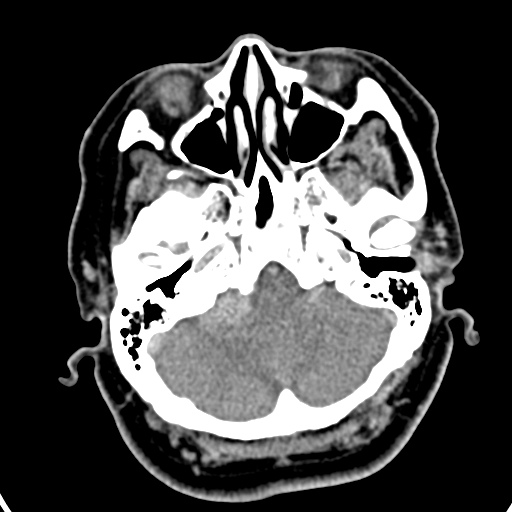 Cerebellopontine angle meningioma (Radiopaedia 35181-36714 A 38).jpg