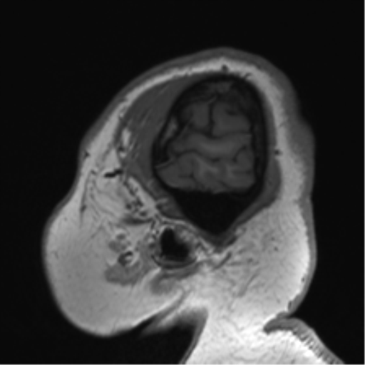 Cerebellopontine angle meningioma (Radiopaedia 48434-53348 Sagittal T1 12).png