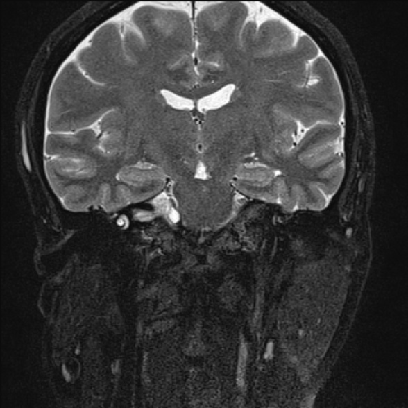 File:Cerebellopontine angle meningioma (Radiopaedia 53561-59591 Coronal T2 9).jpg