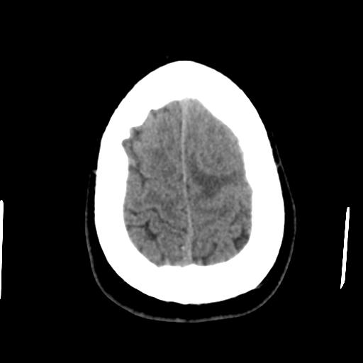 Cerebral abscess (Radiopaedia 29451-29919 Axial non-contrast 44).jpg