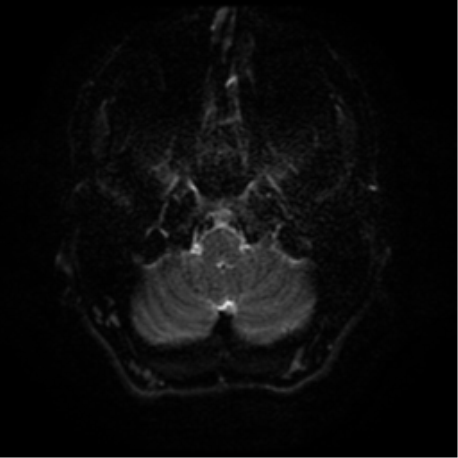 Cerebral abscess (Radiopaedia 57774-64740 Axial DWI 32).png