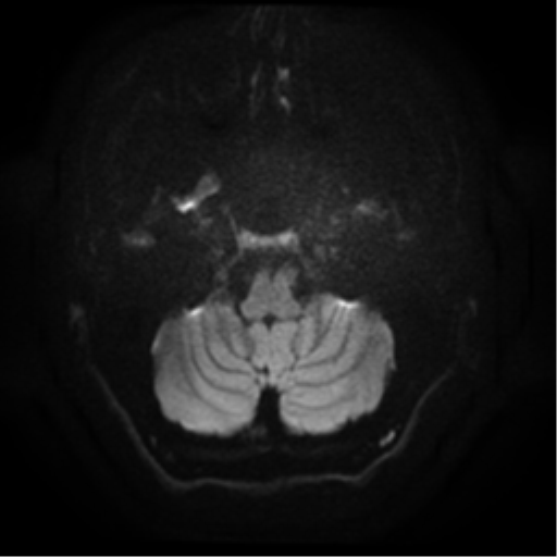 File:Cerebral abscess (Radiopaedia 57774-64740 Axial DWI 4).png