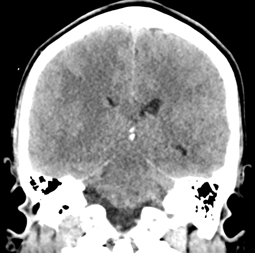 Cerebral abscess (Radiopaedia 60342-68008 Coronal non-contrast 38).png