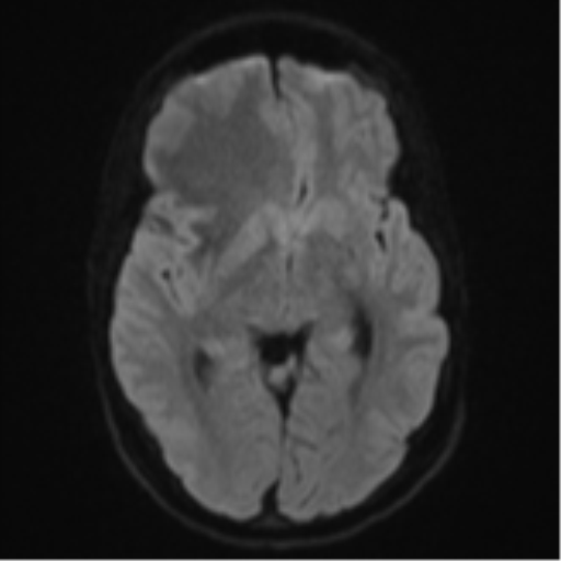 File:Cerebral abscess (Radiopaedia 60342-68009 Axial DWI 52).png