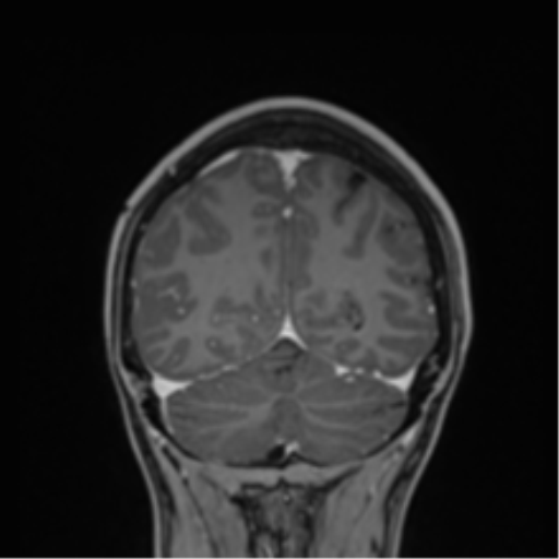 File:Cerebral abscess (Radiopaedia 60342-68009 H 8).png