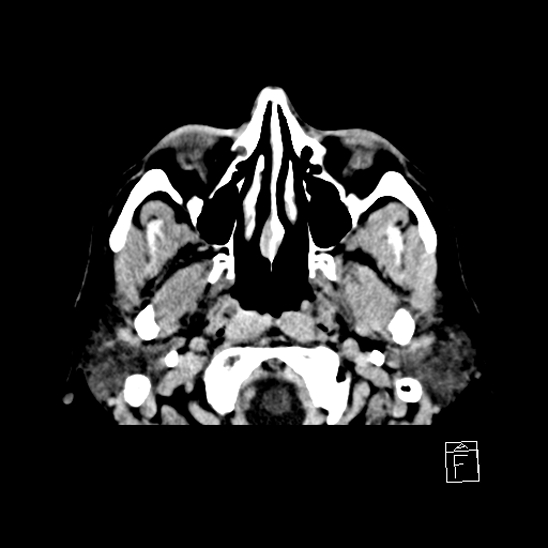 File:Cerebral abscess with ventriculitis (Radiopaedia 78965-91877 A 3).jpg