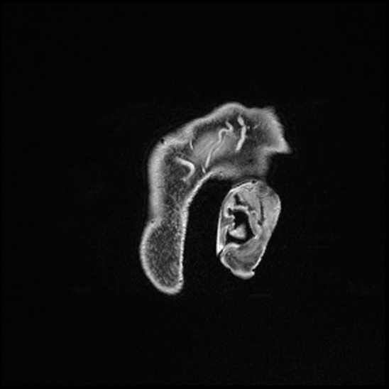 Cerebral abscess with ventriculitis (Radiopaedia 78965-91878 Sagittal T1 C+ 7).jpg
