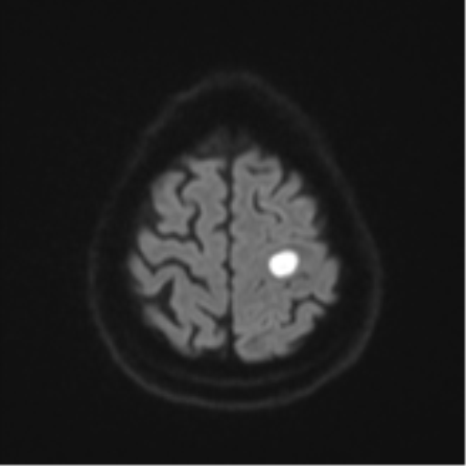 Cerebral abscesses- medically managed (Radiopaedia 45183-49179 Axial DWI 52).png