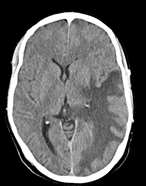 Cerebral abscesses (Radiopaedia 70458-80568 Axial non-contrast 32).jpg