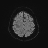 Cerebral amyloid angiopathy-related inflammation (Radiopaedia 74836-85849 Axial DWI 54).jpg