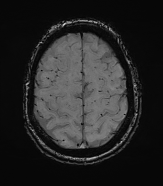 Cerebral amyloid angiopathy (Radiopaedia 46082-50433 Axial SWI 68).png