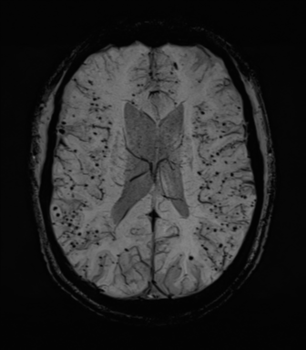 Cerebral amyloid angiopathy (Radiopaedia 46082-50433 Axial SWI MIP 47).png