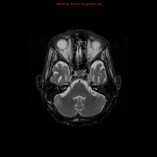 File:Cerebral and orbital tuberculomas (Radiopaedia 13308-13311 Axial T2 6).jpg