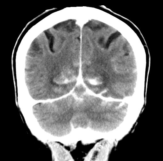 File:Cerebral aneurysm with rupture (Radiopaedia 29933-30460 Coronal non-contrast 28).jpg