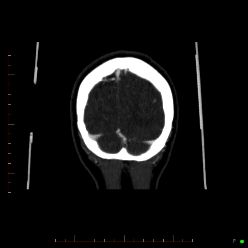 Cerebral arteriovenous malformation (AVM) (Radiopaedia 78162-90706 Coronal CTA 15).jpg