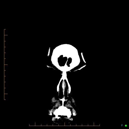 File:Cerebral arteriovenous malformation (AVM) (Radiopaedia 78162-90706 Coronal non-contrast 7).jpg