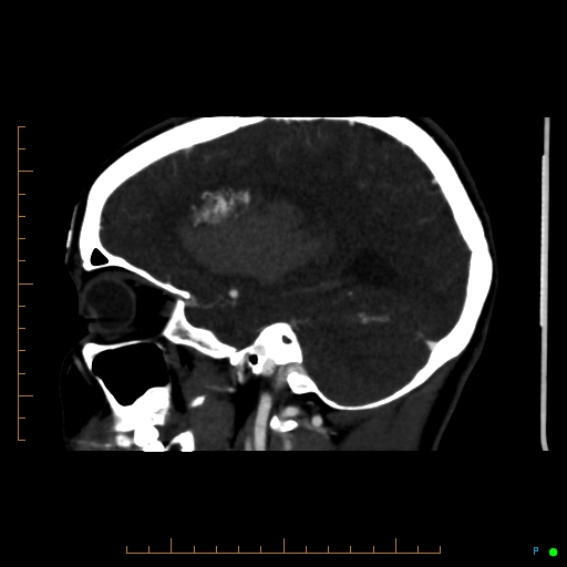 Cerebral arteriovenous malformation (AVM) (Radiopaedia 78162-90706 Sagittal CTA 27).jpg