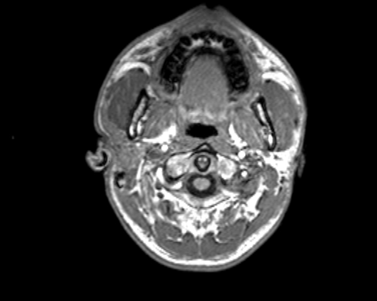 Cerebral arteriovenous malformation (Radiopaedia 30198-30813 Axial T1 54).jpg