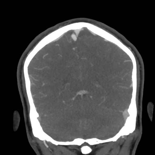 Cerebral arteriovenous malformation (Radiopaedia 39259-41505 E 48).png