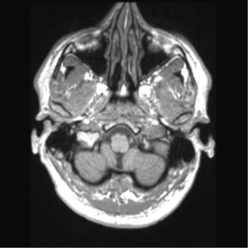 Cerebral arteriovenous malformation (Radiopaedia 39259-41506 Axial T1 12).png